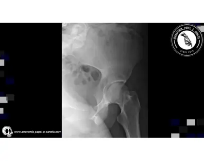 Osso fêmur por rx - 3