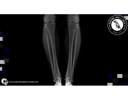 Ossos tíbia e fíbula por rx - 1